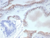 Estrogen Receptor beta 1 Antibody Breast Cancer IHC. Immunohistochemistry staining of FFPE human breast cancer tissue with recombinant Estrogen Receptor beta 1 antibody (clone ESR2/9251R). Inset: PBS used in place of primary Ab (secondary Ab negative control). HIER: boil tissue sections in pH 9 10mM Tris with 1mM EDTA for 20 min and allow to cool before testing.