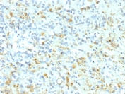 Anaplastic Lymphoma Kinase Antibody Ewing Sarcoma IHC. Immunohistochemistry staining of FFPE human Ewing sarcoma tissue using recombinant monoclonal clone ALK1/9660R demonstrates scattered granular cytoplasmic HRP-DAB brown staining within malignant small round tumor cells embedded in fibrous stromal tissue. The observed staining profile supports detection of Anaplastic Lymphoma Kinase / ALK-associated protein expression in sarcoma-derived neoplastic cellular populations and reinforces the role of ALK pathway signaling in oncogenic kinase biology research. HIER: boil tissue sections in pH 9 10mM Tris with 1mM EDTA for 20 min and allow to cool before testing.