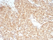 xCT Antibody Triple Negative Breast Cancer IHC. Immunohistochemistry staining of FFPE human triple negative breast cancer tissue using recombinant rabbit monoclonal clone SLC7A11/9136R demonstrates diffuse cytoplasmic and membranous HRP-DAB brown staining in malignant tumor cells, consistent with expression of SLC7A11 / xCT, a cystine-glutamate transporter associated with oxidative stress regulation, glutathione metabolism, and ferroptosis resistance in aggressive breast carcinoma. HIER: boil tissue sections in pH 9 10mM Tris with 1mM EDTA for 20 min and allow to cool before testing.