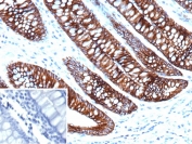 Immunohistochemistry of Cadherin 17 antibody in human colon tissue. The mouse monoclonal clone CDH17/2612 demonstrates strong membranous HRP-DAB brown staining along the lateral borders of colonic epithelial cells, consistent with Cadherin 17 localization in intestinal epithelium. Staining highlights well-organized glandular structures with preserved apical-basal polarity, while surrounding stromal tissue shows minimal background signal. The negative control inset, using PBS in place of the primary antibody, shows no specific staining. Heat-induced epitope retrieval was performed by boiling tissue sections in pH 9 10mM Tris with 1mM EDTA for 20 minutes followed by cooling prior to incubation.