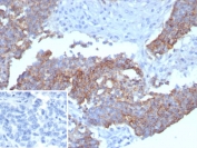 Immunohistochemistry of Recombinant MSLN Antibody in human ovarian carcinoma. Formalin-fixed, paraffin-embedded human ovarian carcinoma shows membranous and cytoplasmic staining of tumor epithelial cells. Clone MSLN/8331R was used following heat-induced epitope retrieval by boiling tissue sections in pH 9 10mM Tris with 1mM EDTA for 20 minutes and cooling at room temperature. The inset shows PBS in place of primary antibody as a secondary-only negative control.
