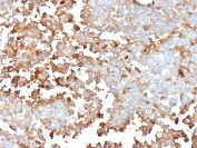 Immunohistochemistry of Periostin antibody mouse monoclonal in human adrenal gland tissue. Formalin-fixed, paraffin-embedded human adrenal gland was stained with mouse monoclonal Periostin antibody (clone POSTN/4096) following heat-induced epitope retrieval by boiling in pH 9 10 mM Tris with 1 mM EDTA for 20 minutes and cooling prior to testing. Brown chromogenic signal is observed predominantly within stromal and extracellular matrix regions surrounding adrenal cortical cell clusters, consistent with the secreted and matrix-associated localization of Periostin, while most adrenal parenchymal nuclei remain negative.
