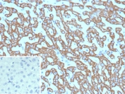 Carbamoyl phosphate synthetase 1 Antibody Hepatocellular Carcinoma Immunohistochemistry. IHC testing of FFPE human hepatocellular carcinoma tissue with Carbamoyl phosphate synthetase 1 antibody (clone CPS1/9865). Inset: PBS used in place of primary Ab (secondary Ab negative control). HIER: boil tissue sections in pH 9 10mM Tris with 1mM EDTA for 20 min and allow to cool before testing.