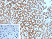 CPSase I Antibody Hepatocellular Carcinoma IHC. Immunohistochemistry of Carbamoyl Phosphate Synthetase 1 / CPS1 in FFPE human hepatocellular carcinoma tissue using mouse monoclonal CPSase I antibody, clone CPS1/9869. Strong HRP-DAB brown cytoplasmic staining highlights tumor cells of hepatocellular origin, consistent with mitochondrial localization of this urea cycle enzyme and supporting its role as a marker of hepatocyte-derived metabolic function, while nuclei are counterstained blue. Inset: PBS was used in place of primary antibody as a negative control to confirm specificity of staining. Heat induced epitope retrieval was performed by boiling tissue sections in pH 9 10 mM Tris with 1 mM EDTA for 20 min followed by cooling prior to staining.