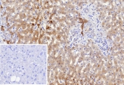 AKR1C1 Antibody Hepatocellular Carcinoma IHC. Immunohistochemistry analysis of FFPE human hepatocellular carcinoma tissue using AKR1C1 Antibody (clone AKR1C1/9318) shows cytoplasmic staining in tumor cells, consistent with AKR1C1 / Dihydrodiol dehydrogenase 1 localization as a detoxification enzyme. The staining is heterogeneous across the tumor field, reflecting variation in metabolic and xenobiotic processing activity. Inset: PBS used in place of primary antibody confirms minimal non-specific background staining. Hematoxylin counterstain provides nuclear contrast and tissue architecture. HIER: boil FFPE tissue sections in pH 9 10 mM Tris with 1 mM EDTA for 20 min and allow to cool before testing.