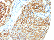 Tissue Factor Antibody Lung Carcinoma IHC. Immunohistochemistry analysis of FFPE human lung carcinoma tissue using Tissue Factor antibody clone CD142/9195. Tumor epithelial cells demonstrate strong membranous and cytoplasmic HRP-DAB brown staining consistent with the surface-associated localization of Tissue Factor / F3 / CD142 in coagulation pathway activation, inflammatory signaling, angiogenic regulation, and tumor-associated procoagulant activity within pulmonary carcinoma tissue. Nuclei are counterstained blue. Heat-induced epitope retrieval was performed by boiling tissue sections in pH9 10 mM Tris with 1 mM EDTA for 20 minutes followed by cooling prior to staining.