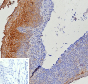 Tissue Factor Antibody Tonsil IHC. Immunohistochemistry analysis of FFPE human tonsil tissue using Tissue Factor antibody clone CD142/9195. Surface epithelial cells demonstrate strong membranous HRP-DAB brown staining consistent with the surface-associated localization of Tissue Factor / F3 / CD142 in inflammatory signaling, coagulation pathway activation, and epithelial immune-response regulation within lymphoid-associated tissue. Adjacent lymphoid regions show comparatively lower staining intensity. Nuclei are counterstained blue. Inset image shows a PBS-only negative control processed without primary antibody, confirming minimal background staining. Heat-induced epitope retrieval was performed by boiling tissue sections in pH9 10 mM Tris with 1 mM EDTA for 20 minutes followed by cooling prior to staining.