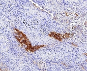 CD142 Antibody Lung IHC. Immunohistochemistry analysis of FFPE human lung tissue using CD142 antibody clone CD142/9196. Bronchial epithelial structures demonstrate prominent membranous and cytoplasmic HRP-DAB brown staining consistent with the surface-associated localization of CD142 / Tissue Factor in coagulation signaling, inflammatory activation, and vascular injury-response pathways within pulmonary tissue. Surrounding stromal regions display comparatively reduced staining intensity. Nuclei are counterstained blue. Heat-induced epitope retrieval was performed by boiling tissue sections in pH9 10 mM Tris with 1 mM EDTA for 20 minutes followed by cooling prior to staining.
