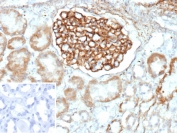 Immunohistochemistry analysis of PLA2R1/Phospholipase A2 receptor 1 antibody in human kidney tissue. Formalin-fixed, paraffin-embedded human kidney shows strong membranous HRP-DAB brown staining within glomerular podocytes, outlining the capillary loops, while surrounding tubular epithelial cells demonstrate comparatively weaker staining. The inset image represents the negative control in which PBS was used in place of the primary antibody, showing no specific brown chromogenic signal. Heat-induced epitope retrieval was performed by boiling tissue sections in pH 9 10mM Tris with 1mM EDTA for 20 minutes followed by cooling prior to immunostaining.
