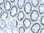 GTBP Antibody MSH6/13194R in Human Colon IHC. Immunohistochemistry testing of GTBP Antibody / G/T mismatch-binding protein / MSH6, clone MSH6/13194R, in FFPE human colon tissue. Strong nuclear staining is observed in colonic epithelial cells, consistent with the nuclear localization of GTBP/MSH6. The inset shows a secondary-only negative control in which PBS was substituted for the primary antibody, demonstrating minimal background staining under the tested conditions.