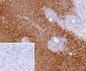 Liver Arginase Antibody (clone ARG1/9447) immunohistochemistry of human hepatocellular carcinoma. Formalin-fixed, paraffin-embedded human hepatocellular carcinoma tissue stained with the mouse monoclonal Liver Arginase Antibody (clone ARG1/9447) shows strong cytoplasmic HRP-DAB brown chromogenic staining in malignant hepatocyte-derived tumor cells, consistent with the known hepatic expression and cytosolic localization of Arginase-1 (ARG1), a key urea cycle enzyme involved in arginine metabolism. The inset shows a PBS-only negative control processed without primary antibody, demonstrating minimal non-specific background staining. Heat-induced epitope retrieval was performed by boiling tissue sections in pH 9 10mM Tris with 1mM EDTA for 20 min followed by cooling prior to antibody incubation.