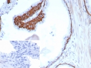 CD13 Antibody Human Prostate IHC. Immunohistochemistry staining of FFPE human prostate tissue with CK13/Cytokeratin 13 antibody (clone KRT13/8577R). Inset: PBS used in place of primary Ab (secondary Ab negative control). HIER: boil tissue sections in pH 9 10mM Tris with 1mM EDTA for 20 min and allow to cool before testing.