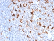 Immunohistochemistry analysis of SPARC antibody in human tonsil tissue (clone OSTN/3761). FFPE human tonsil sections show HRP-DAB brown cytoplasmic and extracellular stromal staining in scattered stromal cells and matrix-rich areas, consistent with Secreted protein acidic and rich in cysteine expression in the extracellular matrix. Surrounding lymphoid cells are largely negative, providing contrast against the positive stromal compartment. Heat induced epitope retrieval was performed by boiling tissue sections in pH 9 10 mM Tris with 1 mM EDTA for 20 minutes followed by cooling prior to antibody incubation.