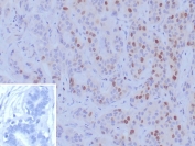 BRCA1 Antibody Human Breast Carcinoma Tissue IHC. Immunohistochemistry staining of FFPE human breast carcinoma tissue with BRCA1 antibody (clone BRCA1/9797R). Inset: PBS used in place of primary Ab (secondary Ab negative control). HIER: boil tissue sections in pH 9 10mM Tris with 1mM EDTA for 20 min and allow to cool before testing.