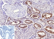 TLE1 Antibody / Groucho Family Transcriptional Corepressor immunohistochemistry analysis of human endometrium tissue using clone rTLE1/13032. Formalin-fixed paraffin-embedded human endometrium tissue shows nuclear staining in glandular epithelial cells consistent with expression of Transducin-Like Enhancer Protein 1, a member of the Groucho family transcriptional corepressor proteins that regulate gene expression through transcriptional repression complexes. Nuclear localization reflects the role of TLE1 as a Groucho family transcriptional corepressor functioning within chromatin-associated regulatory complexes controlling developmental gene expression programs. Stromal cells show weaker staining while epithelial structures demonstrate more prominent nuclear signal. The inset panel shows PBS used in place of the primary antibody as a secondary antibody negative control. Heat-induced epitope retrieval was performed by boiling tissue sections in pH 9 Tris-EDTA buffer for 20 minutes followed by cooling prior to antibody staining.