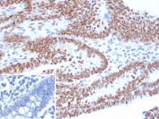 Immunohistochemistry analysis of Tumor Protein 53 antibody in human ovarian carcinoma tissue (clone TP53/8183R). FFPE ovarian carcinoma sections demonstrate strong HRP-DAB brown nuclear staining in the majority of tumor epithelial cells, consistent with accumulation of p53 protein in neoplastic nuclei. The staining pattern is predominantly nuclear, with minimal cytoplasmic background and low stromal signal. This nuclear localization aligns with the role of Tumor protein 53 as a transcription factor regulating cell cycle and DNA damage responses. The inset image shows the PBS secondary-only negative control, confirming absence of specific staining in the control section. Heat induced epitope retrieval was performed by boiling tissue sections in pH 9 10mM Tris with 1mM EDTA for 20 minutes followed by cooling prior to primary antibody incubation.