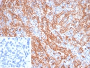 Platelet Glycoprotein 4 Antibody Human Spleen IHC. Immunohistochemical staining of FFPE human spleen demonstrates CD36 expression using Platelet Glycoprotein 4 Antibody clone CD36/7216. Platelet Glycoprotein 4, also known as CD36 and Lipid Uptake Protein, is a class B scavenger receptor involved in fatty acid transport, oxidized lipoprotein uptake, and immune regulation. Prominent membranous staining is observed in splenic macrophages and sinusoidal lining cells, consistent with the known distribution of CD36, while most lymphoid cells exhibit minimal reactivity. The inset shows PBS substituted for the primary antibody as a secondary only negative control. Heat induced epitope retrieval was performed in pH 9 10 mM Tris buffer containing 1 mM EDTA at 95 degrees Celsius for 20 minutes followed by cooling prior to staining. These results support the utility of Platelet Glycoprotein 4 Antibody for studies of lipid metabolism, scavenger receptor biology, inflammation, and immune responses.