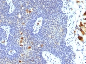 IHC staining of FFPE human cervix tissue with HPV-16 antibody (clone 4B12). Inset: PBS used in place of primary Ab (secondary Ab negative control). HIER: boil tissue sections in pH 9 10mM Tris with 1mM EDTA for 20 min and allow to cool before testing.