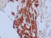 IHC staining of FFPE human mesothelioma tissue with Mesothelial Cell antibody (clone HBME-1). HIER: boil tissue sections in pH 9 10mM Tris with 1mM EDTA for 20 min and allow to cool before testing.