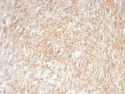 Immunohistochemistry analysis of ANO1 (TMEM16A) expression. ANO1 antibody (clone rDG1/8750) staining was performed on formalin-fixed, paraffin-embedded human gastrointestinal stromal tumor tissue, showing diffuse DAB-positive staining throughout tumor cells, consistent with ANO1 expression in GIST, with hematoxylin counterstaining. Heat-induced epitope retrieval was carried out by boiling tissue sections in Tris buffer (10 mM, pH 9.0) containing EDTA (1 mM) for 10-20 minutes, followed by cooling at room temperature for 20 minutes, and signal detection was achieved using an HRP-conjugated secondary antibody and DAB chromogen.