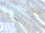 Immunohistochemistry analysis of Cadherin 3 (P-cadherin) expression. CDH3 / Cadherin 3 antibody (clone r56C1) staining was performed on formalin-fixed, paraffin-embedded human colon carcinoma tissue, showing DAB-positive membranous and cytoplasmic staining in tumor epithelial cells, with hematoxylin counterstaining. The inset shows a negative control processed in parallel using PBS in place of the primary antibody, demonstrating minimal background signal with secondary antibody only.