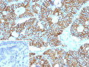 CDH17 Antibody Colon Adenocarcinoma IHC. Immunohistochemistry staining of FFPE human colon adenocarcinoma tissue using CDH17 Antibody / Liver-Intestine Cadherin Antibody (clone CDH17/2613) demonstrates strong membranous HRP-DAB brown staining within malignant gland-forming epithelial cells. The staining pattern is consistent with expression of Cadherin 17 (CDH17, LI-cadherin), a calcium-dependent cell adhesion molecule involved in epithelial organization, maintenance of tissue integrity, and regulation of cell-cell interactions within the gastrointestinal tract. Prominent membrane-associated staining highlights intestinal-type differentiation and preserved glandular architecture within the tumor. The inset image shows the negative control in which PBS was substituted for the primary antibody, demonstrating minimal background staining. HIER was performed by heating tissue sections in 10 mM Tris with 1 mM EDTA, pH 9.0, for 45 minutes at 95 C followed by cooling at room temperature for 20 minutes prior to immunostaining.