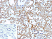 Formalin-fixed, paraffin-embedded human renal cell carcinoma stained with recombinant OX2R/OX-2 receptor antibody (CD200R1/9919R). Tumor cells show predominantly cytoplasmic staining with variable membranous accentuation, while surrounding stromal elements show minimal signal. Inset: PBS instead of primary antibody; secondary-only negative control. Staining of formalin-fixed tissues requires heating tissue sections in 10mM Tris with 1mM EDTA, pH 9.0, for 45 min at 95oC followed by cooling at RT for 20 minutes.