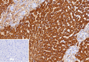 CPS1 Antibody Hepatic Expression IHC. Immunohistochemistry of Carbamoyl Phosphate Synthetase 1 / CPS1 in FFPE human hepatocellular carcinoma tissue using hepatocyte specific antigen CPS1 antibody, clone CPS1/13326R. Strong, diffuse HRP-DAB brown cytoplasmic staining highlights tumor cells of hepatocellular origin, consistent with mitochondrial localization of this urea cycle enzyme and supporting its use as a hepatocyte-associated marker, while surrounding stromal elements show minimal background and nuclei are counterstained blue. Inset: PBS was used in place of primary antibody as a negative control to confirm specificity of staining. Heat induced epitope retrieval was performed in 10 mM Tris with 1 mM EDTA, pH 9, for 45 minutes at 95oC followed by cooling at room temperature for 20 minutes.