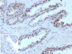 Immunohistochemistry analysis of ERG in human prostate carcinoma tissue. Formalin-fixed, paraffin-embedded human prostate carcinoma tissue was stained using ERG/ETS related gene antibody (clone ERG1/12589), showing distinct nuclear staining in tumor epithelial cells consistent with ERG expression in prostate carcinoma. Heat-induced epitope retrieval was performed by heating tissue sections in 10 mM Tris with 1 mM EDTA, pH 9.0, at 95oC for 45 minutes, followed by cooling at room temperature for 20 minutes. Inset shows PBS substituted for the primary antibody as a secondary-only negative control.