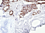 ER beta Antibody Breast Carcinoma IHC. Immunohistochemistry analysis of Estrogen receptor beta 2 in human breast carcinoma. Formalin-fixed, paraffin-embedded human breast carcinoma tissue was stained with ER beta/Estrogen receptor beta antibody (clone ESR2/9710), showing nuclear staining in tumor epithelial cells, with surrounding stromal cells largely negative. Hematoxylin was used as a nuclear counterstain. Inset shows a negative control section processed with PBS instead of the primary antibody, followed by secondary antibody only. Staining of formalin-fixed tissues required heating tissue sections in 10mM Tris with 1mM EDTA, pH 9.0, for 45 min at 95oC followed by cooling at room temperature.