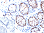 Intestinal fatty acid-binding protein Antibody Colon IHC. Immunohistochemistry of FABP2 in human colon tissue. Formalin-fixed, paraffin-embedded human colon tissue was stained with Intestinal fatty acid-binding protein/I-FABP antibody (clone FABP2/6936). Brown chromogenic signal indicates FABP2-positive epithelial cells within colonic glands, with staining localized to the cytoplasmic compartment of glandular epithelial cells. Inset shows PBS used in place of the primary antibody as a secondary-only negative control. Staining of formalin-fixed tissues required heating tissue sections in 10mM Tris with 1mM EDTA, pH 9.0, for 45 min at 95oC followed by cooling at room temperature for 20 minutes.