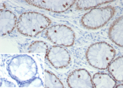 Immunohistochemistry analysis of SATB2 in human colon tissue. Formalin-fixed, paraffin-embedded human colon tissue stained with SATB2 antibody mouse monoclonal SATB2/7489. Nuclear brown chromogenic staining is observed in colonic epithelial cells, consistent with SATB2-positive nuclei. Inset shows PBS instead of primary antibody as a secondary-only negative control. Staining of formalin-fixed tissues requires heating tissue sections in 10mM Tris with 1mM EDTA, pH 9.0, for 45 min at 95oC followed by cooling at RT for 20 minutes.