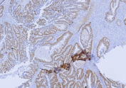 SATB2 Transcription Factor Antibody Colon Carcinoma IHC. Immunohistochemistry analysis of SATB2 in human colon carcinoma. Formalin-fixed, paraffin-embedded human colon carcinoma tissue shows strong nuclear brown chromogenic staining in tumor epithelial cells using recombinant SATB2 Transcription Factor antibody (clone SATB2/9432R), consistent with nuclear localization of the SATB2 transcription factor in colorectal carcinoma cells. Staining of formalin-fixed tissues requires heating tissue sections in 10mM Tris with 1mM EDTA, pH 9.0, for 45 min at 95oC followed by cooling at RT for 20 minutes.