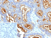 Immunohistochemistry analysis of CEACAM6 / CD66c antibody (clone CEACAM6/13371R). Formalin-fixed, paraffin-embedded human colon carcinoma tissue shows strong membranous and apical cytoplasmic brown chromogenic staining in tumor epithelial cells, consistent with CEACAM6 expression. The inset image shows PBS used instead of primary antibody as a negative control and demonstrates absence of specific staining. Heat-induced epitope retrieval was performed by boiling tissue sections in 10mM Tris with 1mM EDTA, pH 9.0, for 45 min at 95oC followed by cooling at RT for 20 minutes.