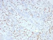 Immunohistochemistry analysis of Paired box protein 2 / PAX2 antibody in human renal cell carcinoma. FFPE human renal cell carcinoma tissue was stained with Paired box protein 2 / PAX2 antibody (clone rPAX2/8506). HRP-DAB brown chromogenic signal is observed predominantly in the nuclei of tumor epithelial cells, consistent with the expected nuclear localization of PAX2. Tumor cells show strong nuclear brown staining with minimal cytoplasmic background, while surrounding stromal components display little to no specific signal. Nuclei are counterstained blue. Heat-induced epitope retrieval was performed in 10 mM Tris with 1 mM EDTA, pH 9.0, for 45 minutes at 95oC followed by cooling at room temperature for 20 minutes prior to antibody incubation.