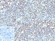 Immunohistochemistry analysis of Transcriptional Corepressor BCOR antibody in human tonsil tissue. Formalin-fixed, paraffin-embedded human tonsil stained with BCOR Recombinant Rabbit Monoclonal Antibody (clone BCOR/13087R) demonstrates predominant nuclear HRP-DAB brown staining in lymphoid cells within germinal center and interfollicular regions, consistent with the known nuclear localization of BCL-6 corepressor. Background stromal elements show minimal staining. The inset image represents the negative control in which PBS was used instead of the primary antibody, confirming absence of non-specific secondary antibody binding. Heat-induced epitope retrieval was performed by boiling tissue sections in pH 9, 10mM Tris with 1mM EDTA for 45 minutes at 95oC followed by cooling prior to immunostaining.