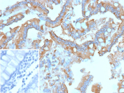 Immunohistochemistry analysis of RET Proto-Oncogene/Colorectal Cancer Marker antibody (clone r3F8) in human colon carcinoma tissue. FFPE human colon carcinoma shows membranous and cytoplasmic HRP-DAB brown staining in malignant epithelial cells lining glandular structures, consistent with RET expression. Staining highlights tumor cell membranes with additional cytoplasmic signal, while surrounding stromal elements demonstrate comparatively weaker reactivity. Nuclei are counterstained blue. The inset image represents a secondary antibody negative control in which PBS was used in place of the primary antibody and shows absence of specific staining. Heat induced epitope retrieval was performed by heating tissue sections in 10 mM Tris with 1 mM EDTA, pH 9.0, at 95oC for 45 minutes followed by cooling at room temperature for 20 minutes prior to immunostaining.