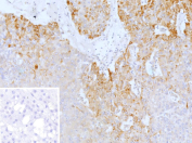 Immunohistochemistry analysis of PRPH/Peripherin antibody in human adrenal gland tissue. FFPE human adrenal sections show HRP-DAB brown cytoplasmic staining in neuronal elements and nerve fibers within the adrenal medulla, consistent with Peripherin expression in peripheral neuroendocrine-associated cells. Cortical cells demonstrate minimal to no staining. The inset negative control, in which PBS was used in place of primary antibody, shows no specific brown chromogenic signal. Heat induced epitope retrieval was performed in 10 mM Tris with 1 mM EDTA, pH 9.0, by heating at 95oC for 45 minutes followed by cooling at room temperature for 20 minutes.