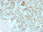 Immunohistochemistry analysis of CXCR5 Chemokine Receptor antibody in human adrenal gland tissue. FFPE human adrenal sections show HRP-DAB brown membranous and cytoplasmic staining in scattered immune-associated cells within the adrenal medulla, consistent with CD185 expression in lymphoid cells. Adrenocortical cells demonstrate minimal background staining. The inset negative control, in which PBS was used in place of primary antibody, shows no specific brown chromogenic signal. Heat induced epitope retrieval was performed in 10 mM Tris with 1 mM EDTA, pH 9.0, by heating at 95oC for 45 minutes followed by cooling at room temperature for 20 minutes.