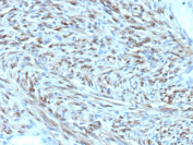 Signal Transducer 6 Antibody Liposarcoma IHC. Immunohistochemical analysis of STAT6 expression in formalin-fixed, paraffin-embedded human liposarcoma tissue using Signal Transducer 6 antibody clone STAT6/12798R. Strong nuclear HRP-DAB brown staining is observed in spindle-shaped tumor cells arranged in fascicles, consistent with activated STAT6 signaling and nuclear translocation. HIER: heating in pH 9 Tris-EDTA buffer followed by cooling prior to staining.