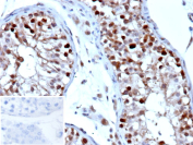 Immunohistochemistry analysis of NANOG Transcription Factor/Nanog antibody (clone NANOG/9704) in human testis tissue. Formalin-fixed, paraffin-embedded human testis demonstrates predominant nuclear HRP-DAB brown staining in subsets of germ cells within seminiferous tubules, consistent with NANOG expression, while surrounding stromal cells show minimal staining. Nuclear counterstain highlights tissue architecture. The inset shows PBS used in place of primary antibody as a negative control, confirming absence of specific staining. Heat-induced epitope retrieval was performed by heating tissue sections in 10 mM Tris with 1 mM EDTA, pH 9.0, for 45 minutes at 95oC followed by cooling at room temperature for 20 minutes prior to staining.