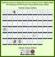 CD20 Antibody for IHC Tissue Microarray (TMA). Immunohistochemistry analysis of CD20 molecule MS4A1 in formalin-fixed paraffin-embedded human normal and cancer tissue microarrays using recombinant rabbit monoclonal CD20 antibody clone MSVA-020R. Tissue microarray (TMA) staining with HRP-DAB brown chromogen demonstrates strong membranous localization in B lymphocyte populations within tonsil, lymph node, and spleen, while non-lymphoid epithelial and stromal tissues remain largely negative. Within tumor tissue microarrays, diffuse membranous staining is observed in B cell lymphomas, enabling clear identification of B cell lineage malignancies, whereas most non-hematologic tumors show minimal to no staining. Evaluation across large TMA panels enables direct comparison of MS4A1 expression across diverse tissue types under standardized conditions. The observed staining patterns align with reported CD20 expression profiles in the Human Protein Atlas, supporting reliable detection of B lymphocytes and lymphoma characterization.