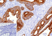 Immunohistochemistry analysis of Cancer antigen 125 Antibody (Clone CA125/8893) in FFPE human colon carcinoma tissue. Strong apical and membranous HRP-DAB brown staining is observed in malignant gland-forming epithelial cells, consistent with MUC16 / CA125 expression in colon carcinoma, while adjacent stromal elements are largely negative. The inset shows PBS used in place of the primary antibody as a secondary-only negative control. Heat-induced epitope retrieval was performed in 10mM Tris with 1mM EDTA, pH 9.0, at 95oC for 45 minutes followed by cooling at room temperature for 20 minutes.