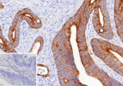 Immunohistochemistry analysis of CA125 Antibody (Clone CA125/9923R) in FFPE human colon carcinoma tissue. Strong apical and membranous HRP-DAB brown staining is observed in malignant gland-forming epithelial cells, consistent with MUC16 / cancer antigen 125 expression in colon carcinoma, while adjacent stromal elements are largely negative. This CA125 Antibody for IHC demonstrates clear epithelial surface localization within tumor glands. The inset shows PBS used in place of the primary antibody as a secondary-only negative control. Heat-induced epitope retrieval was performed in 10mM Tris with 1mM EDTA, pH 9.0, at 95oC for 45 minutes followed by cooling at room temperature for 20 minutes.