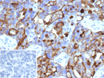 Immunohistochemistry analysis of Ovarian cancer antigen 125 Antibody (Clone CA125/13895R) in FFPE human ovarian carcinoma tissue. Prominent membranous and apical cytoplasmic HRP-DAB brown staining is observed in malignant epithelial cells, consistent with MUC16 / CA125 overexpression in ovarian carcinoma, while adjacent stromal elements are largely negative. Clone CA125/13895R demonstrates distinct cell surface localization. The inset shows PBS used in place of the primary antibody as a secondary-only negative control. Heat-induced epitope retrieval was performed in 10mM Tris with 1mM EDTA, pH 9.0, at 95oC for 45 minutes followed by cooling at room temperature for 20 minutes.