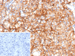Immunohistochemistry of CD70 Molecule Antibody in human renal cell carcinoma tissue. FFPE renal cell carcinoma shows strong membranous HRP-DAB brown staining in tumor epithelial cells, consistent with CD70 expression in malignant cells. Clone CD70/12768R was used for detection. Heat-induced epitope retrieval was performed by heating tissue sections in 10 mM Tris with 1 mM EDTA, pH 9.0, at 95oC for 45 minutes followed by cooling at room temperature for 20 minutes. Inset shows PBS used in place of primary antibody as a secondary-only negative control.