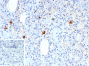 Immunohistochemistry of HCMV pp65 antibody in human CMV-infected tissue. FFPE human cytomegalovirus-infected tissue shows distinct cytoplasmic HRP-DAB brown staining in scattered infected cells against a background of hematoxylin-stained nuclei, consistent with UL83 / pp65 expression in virally infected cells. Clone r6, a recombinant mouse monoclonal antibody, was used for detection. An inset image shows PBS substituted for the primary antibody as a negative control, confirming absence of specific staining. Heat-induced epitope retrieval was performed by heating sections in 10 mM Tris with 1 mM EDTA, pH 9.0, for 45 minutes at 95oC followed by cooling at room temperature for 20 minutes prior to staining.
