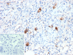 Immunohistochemistry of Phosphoprotein 65 antibody in human CMV-infected tissue. FFPE human cytomegalovirus-infected tissue demonstrates focal cytoplasmic HRP-DAB brown staining in scattered infected cells, consistent with UL83 / pp65 expression during active viral infection. Clone rCMV/12688, a recombinant mouse monoclonal antibody, was used for detection. An inset image shows PBS substituted for the primary antibody as a negative control, confirming absence of specific staining. Heat-induced epitope retrieval was performed by heating sections in 10 mM Tris with 1 mM EDTA, pH 9.0, for 45 minutes at 95oC followed by cooling at room temperature for 20 minutes prior to staining.