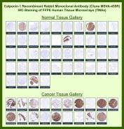 CNN1 Antibody Tissue Microarray (TMA) IHC. Immunohistochemistry analysis of Calponin 1 / CNN1 in FFPE human normal and cancer tissue microarrays using CNN1 Antibody for IHC clone MSVA-455R, a marker of smooth muscle tissue architecture. Tissue microarray staining with HRP-DAB brown chromogen shows strong cytoplasmic signal in smooth muscle cell populations, including vascular walls and gastrointestinal muscular layers, as well as myoepithelial cells in select glandular tissues, while most non-smooth muscle tissues display minimal staining. In cancer tissue arrays, robust positivity is observed in smooth muscle tumors such as leiomyoma and leiomyosarcoma, whereas non-mesenchymal malignancies are largely negative. Evaluation across TMA panels enables direct comparison of CNN1 expression across diverse tissue types under standardized conditions.