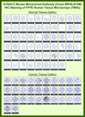 S100A12 Antibody for IHC Tissue Microarray (TMA). Immunohistochemistry analysis of S100 calcium binding protein A12 S100A12 in formalin-fixed paraffin-embedded human normal and cancer tissue microarrays using recombinant mouse monoclonal S100A12 antibody clone MSVA-812M. Tissue microarray (TMA) staining with HRP-DAB brown chromogen demonstrates cytoplasmic localization in scattered inflammatory cells, particularly neutrophils and other myeloid-derived populations, while epithelial and stromal compartments remain largely negative. Positive staining highlights infiltrating granulocytes across multiple tissue types, consistent with the role of S100A12 in innate immune responses and inflammatory processes. The observed TMA staining patterns across the panel align with reported S100A12 expression profiles in the Human Protein Atlas.